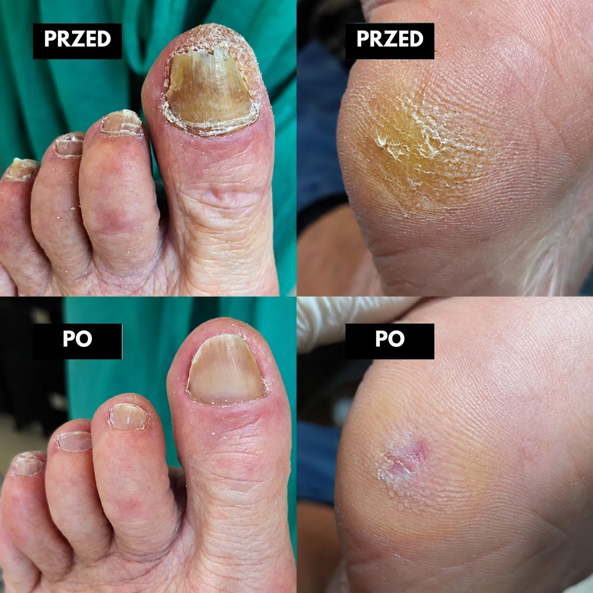 Efekt terapii podologicznej przed i po – FootMed